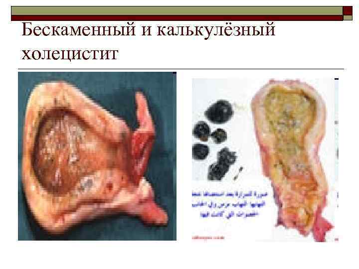Бескаменный и калькулёзный холецистит 
