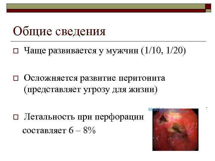 Общие сведения o Чаще развивается у мужчин (1/10, 1/20) o Осложняется развитие перитонита (представляет