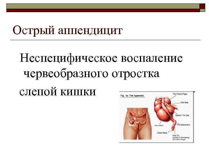 Острый аппендицит Неспецифическое воспаление червеобразного отростка слепой кишки 