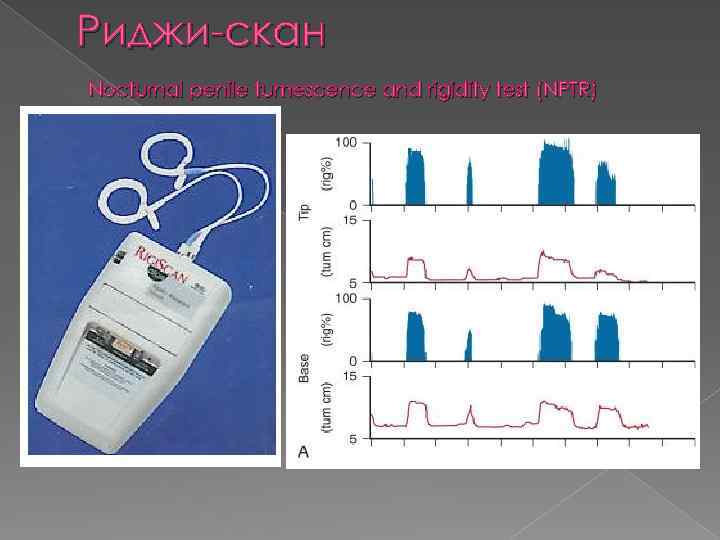 Риджи-скан Nocturnal penile tumescence and rigidity test (NPTR) 