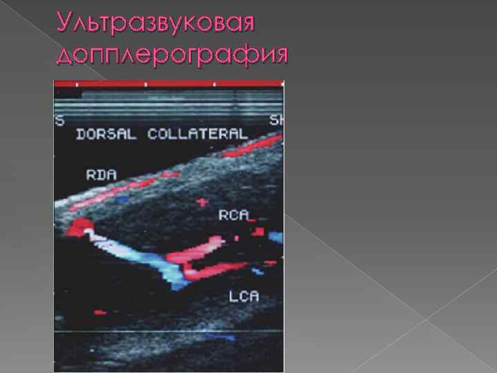 Ультразвуковая допплерография 