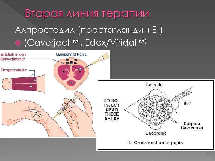 Вторая линия терапии Алпростадил (простагландин E 1) (Caverject. TM , Edex/Viridal. TM) 