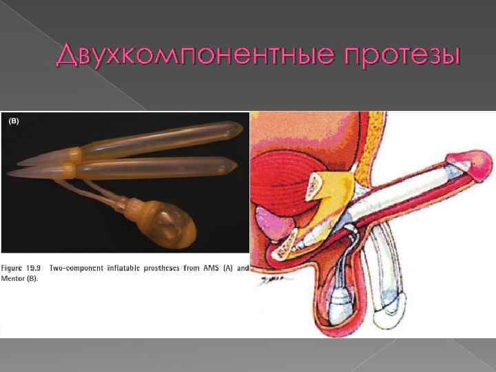 Двухкомпонентные протезы 