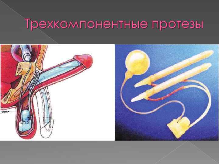 Трехкомпонентные протезы 