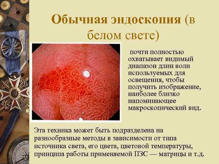 Обычная эндоскопия (в белом свете) почти полностью охватывает видимый диапазон длин волн используемых для