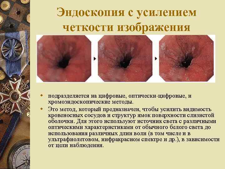 Эндоскопия с усилением четкости изображения w подразделяется на цифровые, оптически-цифровые, и хромоэндоскопические методы. w