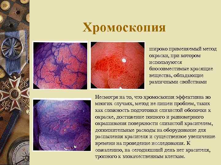 Хромоскопия широко применяемый метод окраски, при котором используются биосовместимые красящие вещества, обладающие различными свойствами