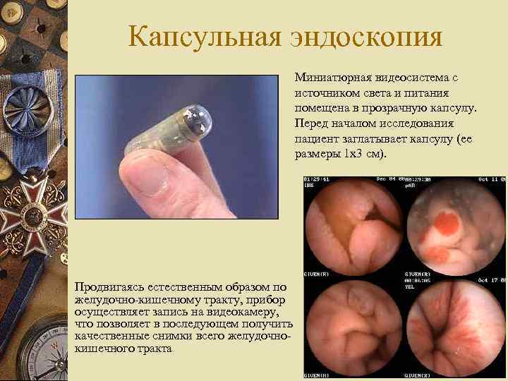 Капсульная эндоскопия Миниатюрная видеосистема с источником света и питания помещена в прозрачную капсулу. Перед