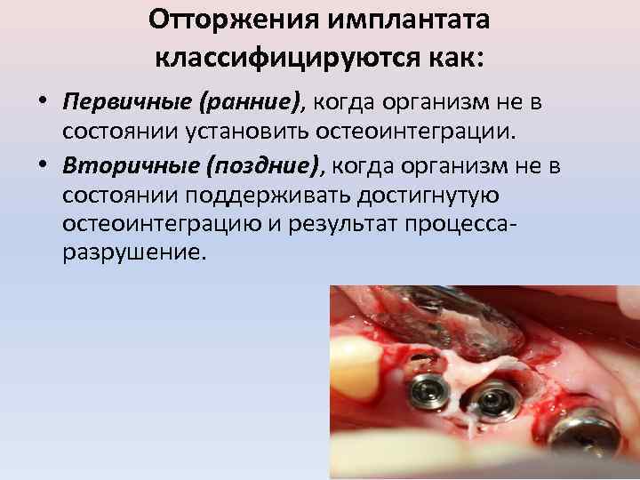 Отторжения имплантата классифицируются как: • Первичные (ранние), когда организм не в состоянии установить остеоинтеграции.