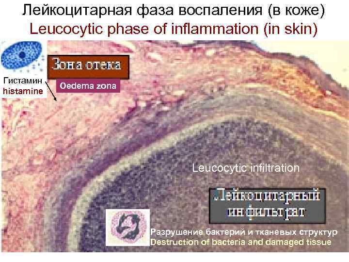 Лейкоцитарная фаза воспаления (в коже) Leucocytic phase of inflammation (in skin) Гистамин histamine Oedema