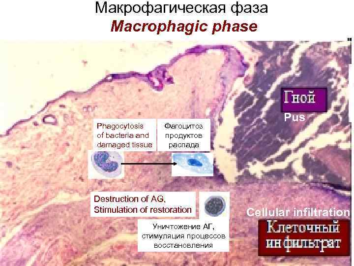 Макрофагическая фаза Macrophagic phase Phagocytosis of bacteria and damaged tissue Фагоцитоз продуктов распада Destruction
