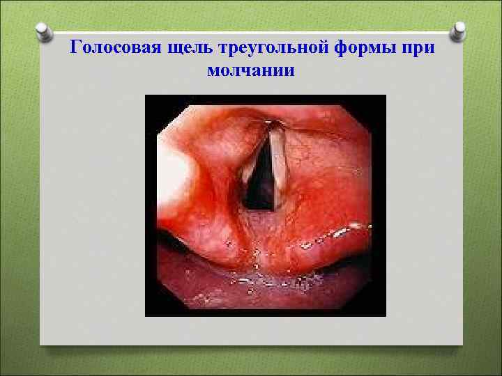  Голосовая щель треугольной формы при молчании 