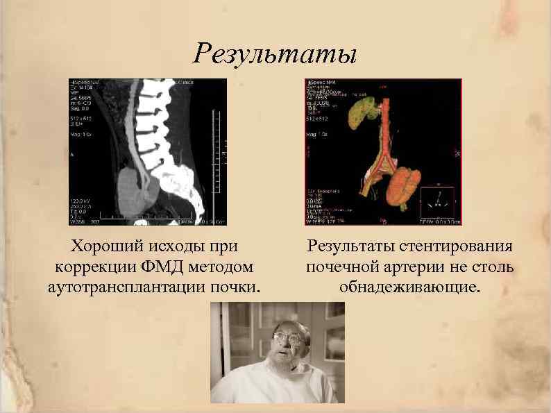 Результаты Хороший исходы при коррекции ФМД методом аутотрансплантации почки. Результаты стентирования почечной артерии не