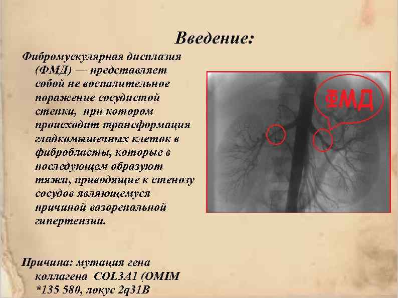 Введение: Фибромускулярная дисплазия (ФМД) — представляет собой не воспалительное поражение сосудистой стенки, при котором