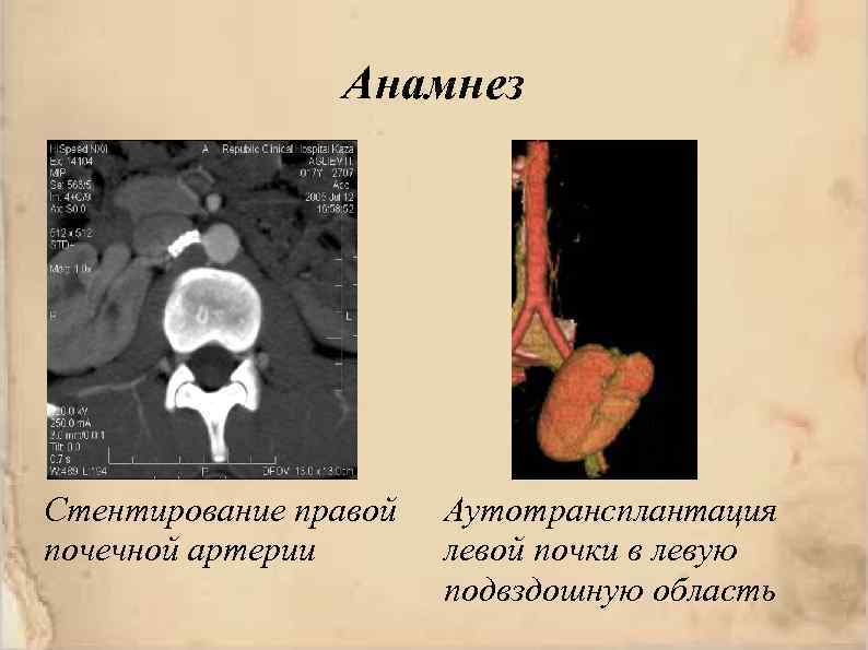 Анамнез Стентирование правой почечной артерии Аутотрансплантация левой почки в левую подвздошную область 