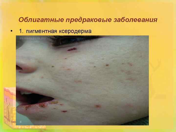 Облигатные предраковые заболевания • 1. пигментная ксеродерма 
