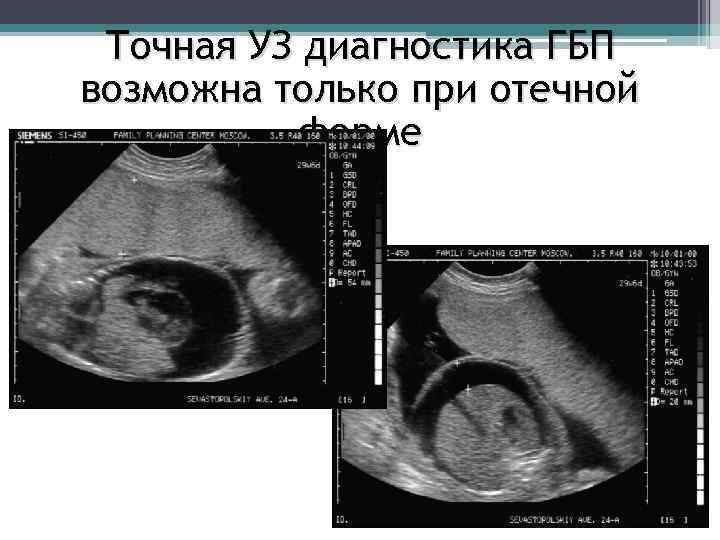 Точная УЗ диагностика ГБП возможна только при отечной форме 