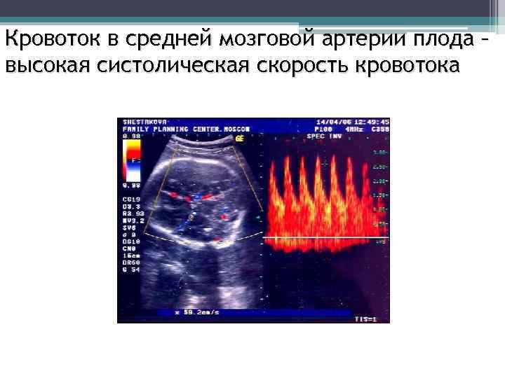 Измерение кровотока. Скорость кровотока в средней мозговой артерии плода. Систолическая скорость кровотока в средней мозговой артерии плода. Пиковая систолическая скорость кровотока в средней мозговой артерии. УЗДГ средней мозговой артерии плода.