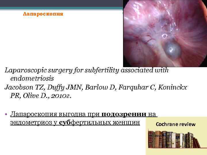 Лапароскопия Laparoscopic surgery for subfertility associated with endometriosis Jacobson TZ, Duffy JMN, Barlow D,