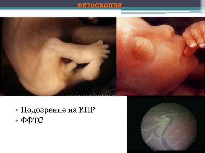 ФЕТОСКОПИЯ • Подозрение на ВПР • ФФТС 