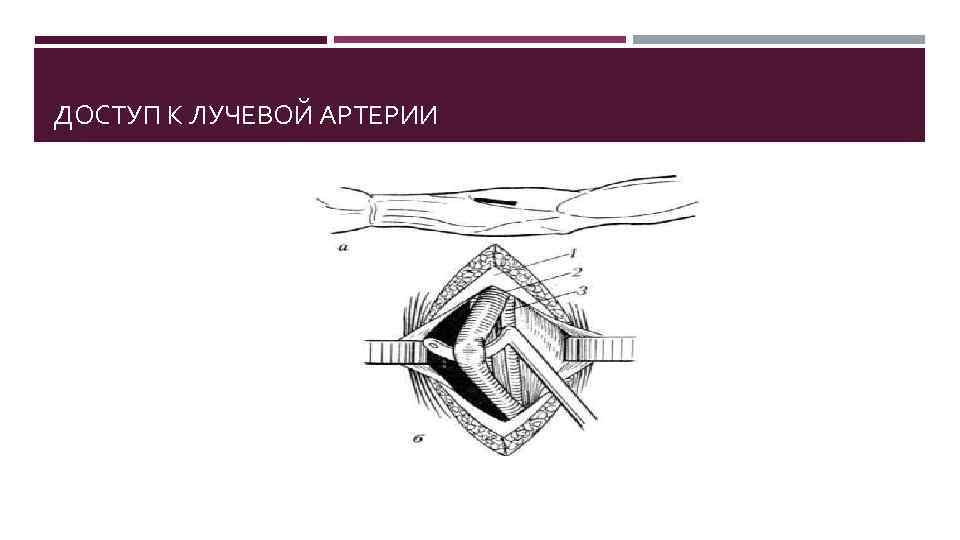 ДОСТУП К ЛУЧЕВОЙ АРТЕРИИ 