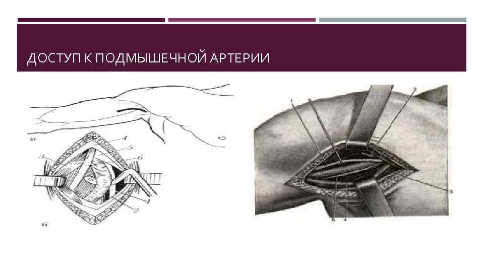 ДОСТУП К ПОДМЫШЕЧНОЙ АРТЕРИИ 