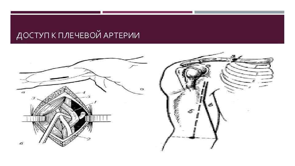 ДОСТУП К ПЛЕЧЕВОЙ АРТЕРИИ 