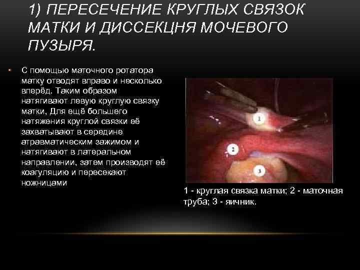 1) ПЕРЕСЕЧЕНИЕ КРУГЛЫХ СВЯЗОК МАТКИ И ДИССЕКЦНЯ МОЧЕВОГО ПУЗЫРЯ. • С помощью маточного ротатора