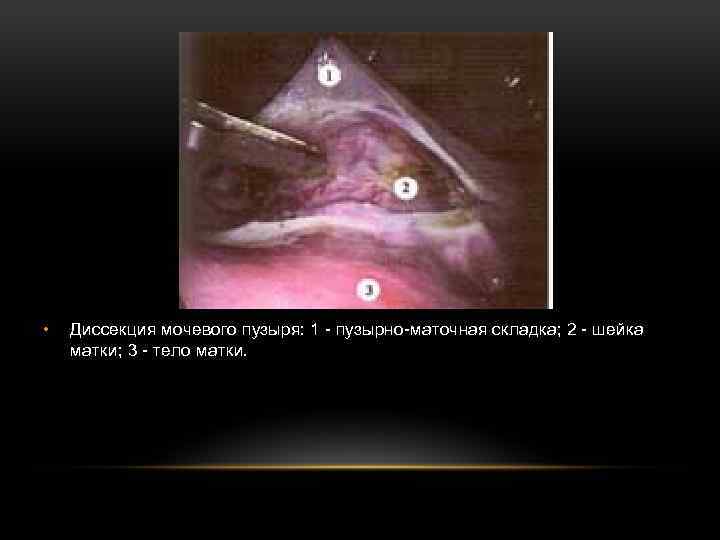  • Диссекция мочевого пузыря: 1 - пузырно-маточная складка; 2 - шейка матки; 3