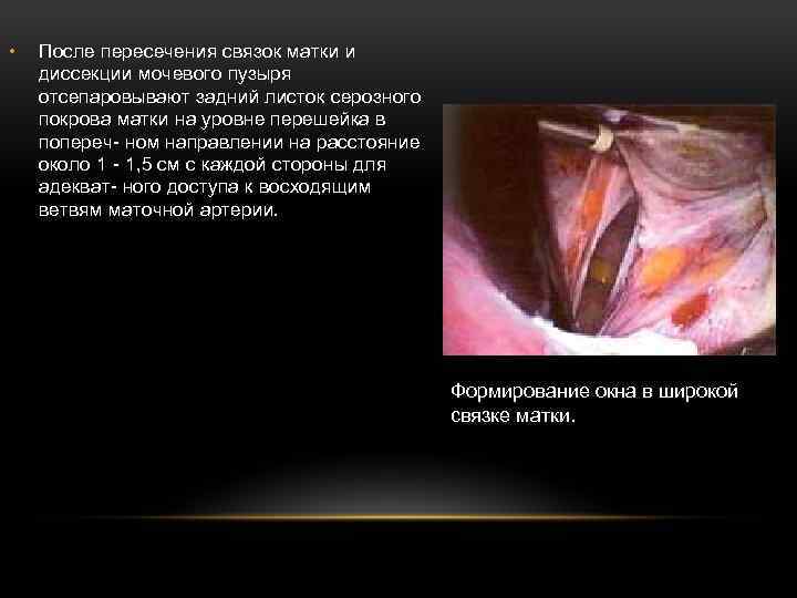  • После пересечения связок матки и диссекции мочевого пузыря отсепаровывают задний листок серозного