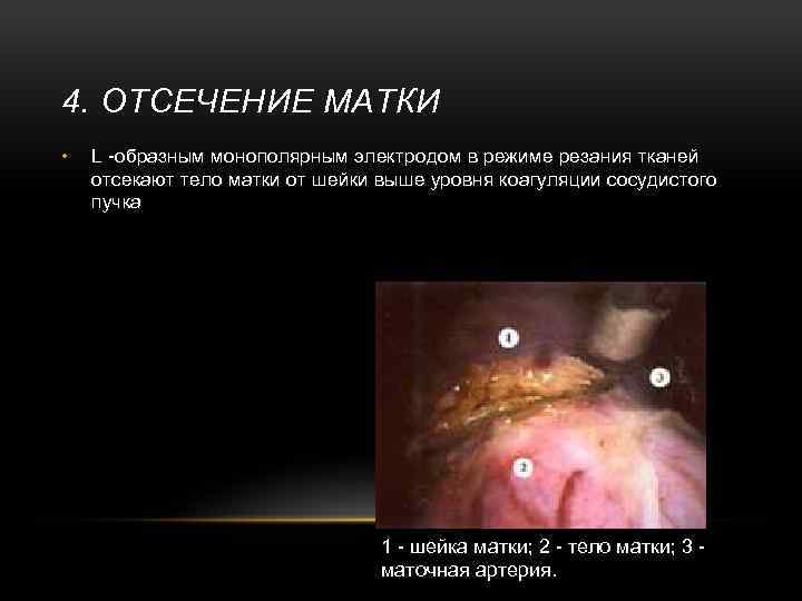 4. ОТСЕЧЕНИЕ МАТКИ • L -образным монополярным электродом в режиме резания тканей отсекают тело