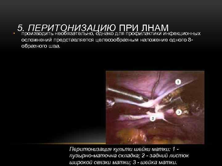  • 5. ПЕРИТОНИЗАЦИЮ ПРИ ЛНАМ производить необязательно, однако для профилактики инфекционных осложнений представляется