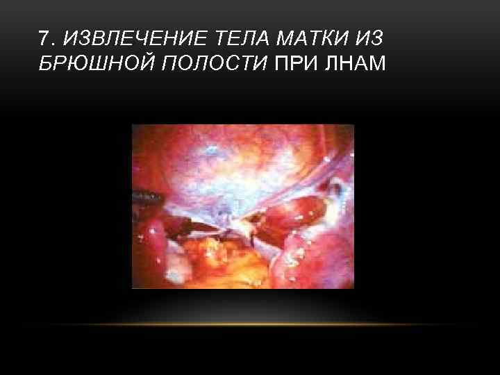 7. ИЗВЛЕЧЕНИЕ ТЕЛА МАТКИ ИЗ БРЮШНОЙ ПОЛОСТИ ПРИ ЛНАМ 