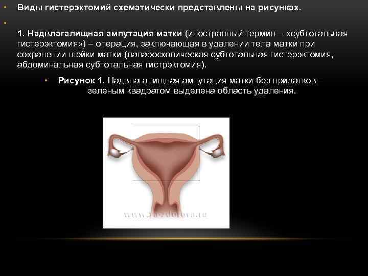  • Виды гистерэктомий схематически представлены на рисунках. • 1. Надвлагалищная ампутация матки (иностранный