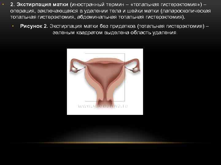  • 2. Экстирпация матки (иностранный термин – «тотальная гистерэктомия» ) – операция, заключающаяся