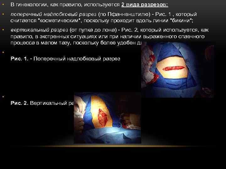  • В гинекологии, как правило, используются 2 вида разрезов: • поперечный надлобковый разрез