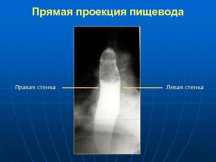 Прямая проекция пищевода Правая стенка Левая стенка 
