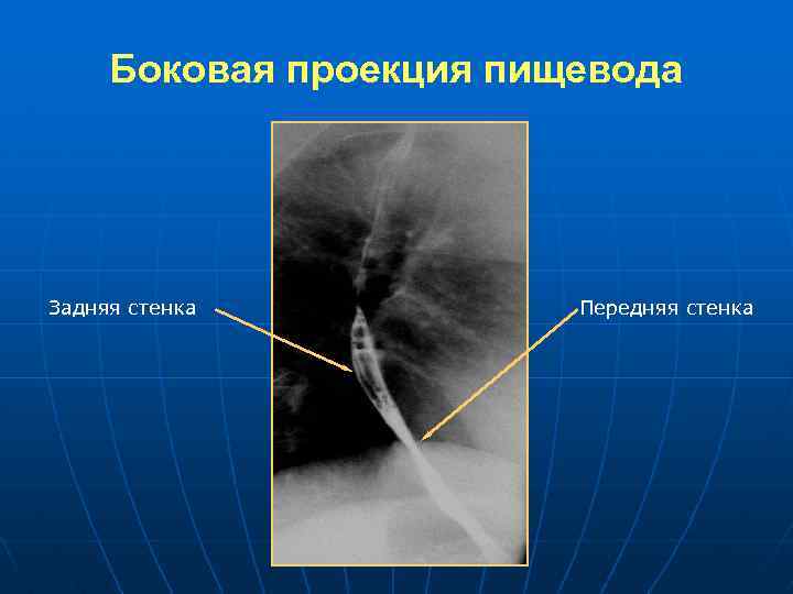 Схема рентгенограммы контрастированного пищевода