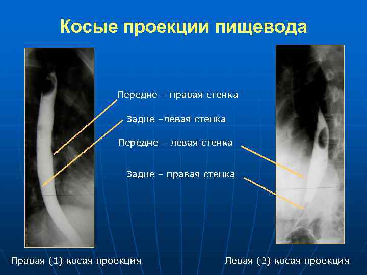 Косая проекция. Правая косая проекция пищевода. Левая косая проекция пищевода. Первая косая проекция пищевода. Передняя стенка пищевода.