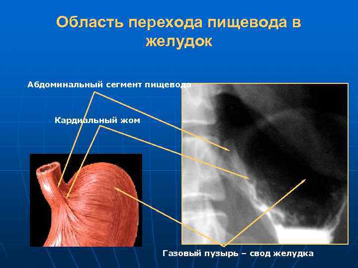 Сегменты пищевода по бромбару схема