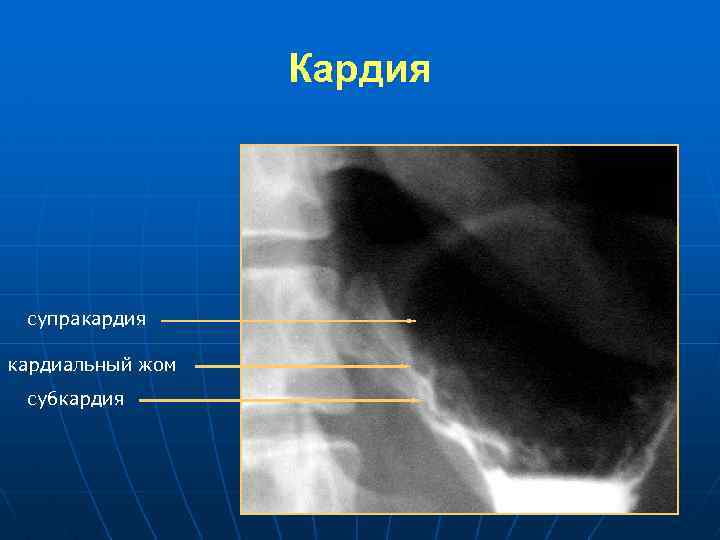 Кардия супракардия кардиальный жом субкардия 