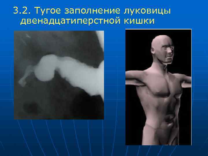 3. 2. Тугое заполнение луковицы двенадцатиперстной кишки 