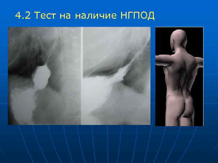 4. 2 Тест на наличие НГПОД 