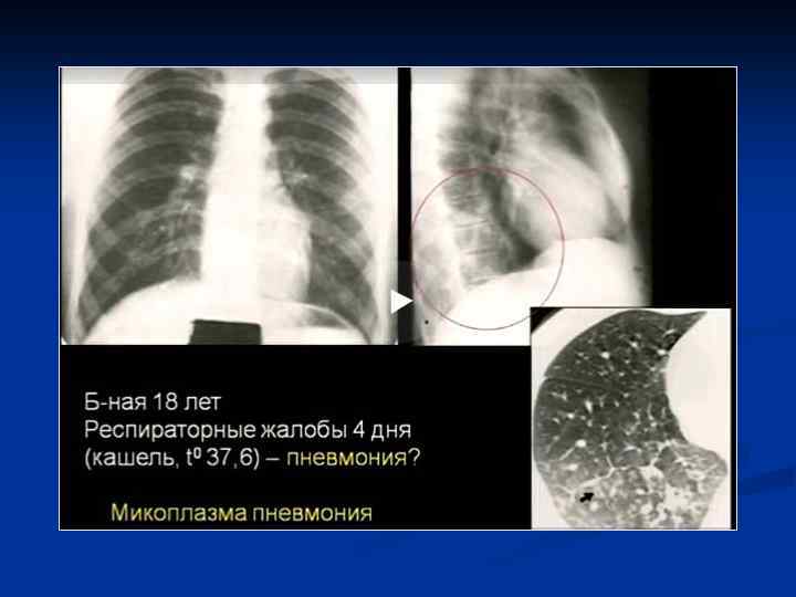 Симптом воздушной ловушки на компьютерных томограммах визуализируется как