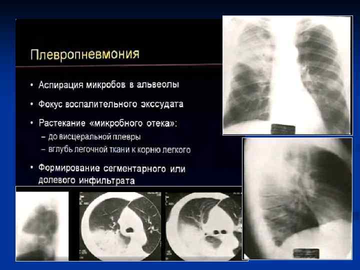 Гипостатическая пневмония карта вызова