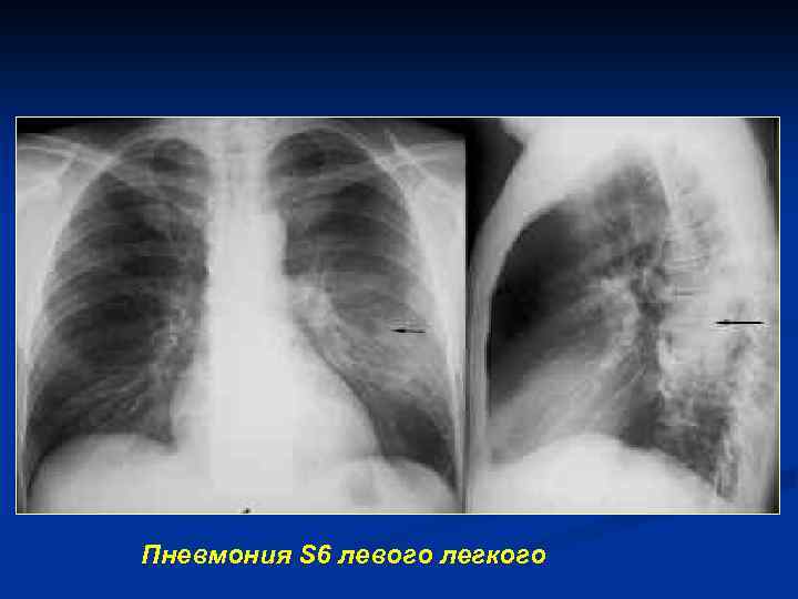 Пневмония в правом легком в нижней доле. Пневмония нижней доли левого легкого рентген. Пневмония правосторонняя s4 s5. Пневмония нижней доли левого легкого рентгенограмма. S3 s4 левого легкого пневмония.