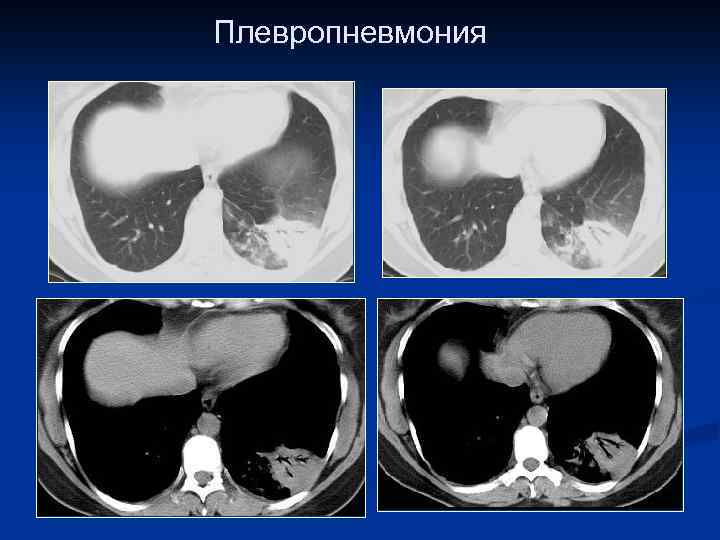 Плевропневмония