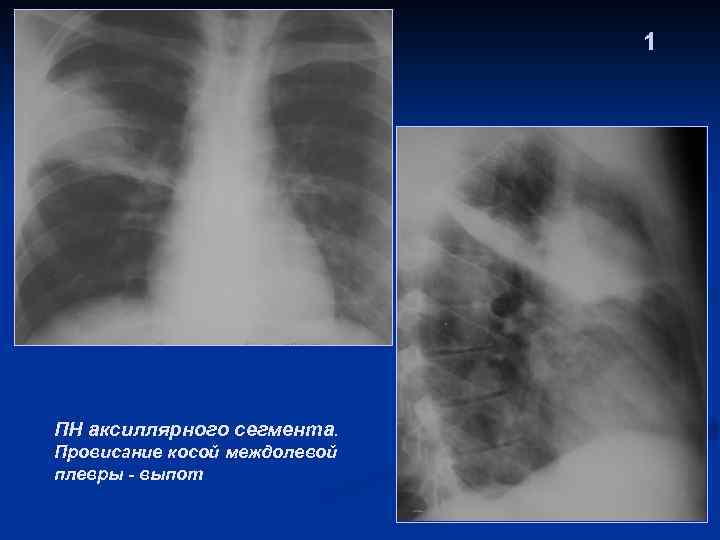 1 ПН аксиллярного сегмента. Провисание косой междолевой плевры - выпот 