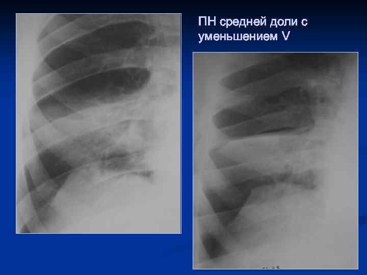 ПН средней доли с уменьшением V 