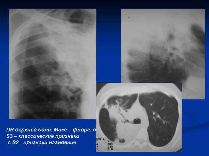 ПН верхней доли. Микс – флора: в S 3 – классические признаки в S